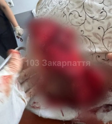 Тяжка травма на Закарпатті: 17-річний хлопець ледь не втратив ногу та кисть через циркулярну пилу