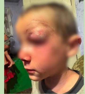 У Білгород-Дністровському району п’ятирічний хлопчик потрапив до лікарні після побиття власною матір’ю: жінка раніше була засуджена за вбивство іншої дитини