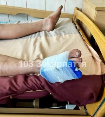 Укус змії на подвір'ї в Закарпатті: молодого закарпатця направили до реанімації