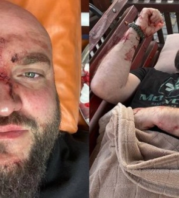 Зламана рука, ніс, пробита голова: у Затоці чоловік арматурою побив військового через зауваження про російську музику. ВІДЕО+ФОТОрепортаж