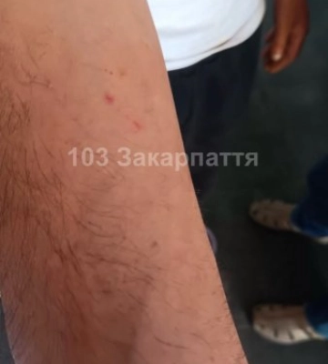 На Тячівщині чоловіка госпіталізували з підозрою на укус змії: що відомо