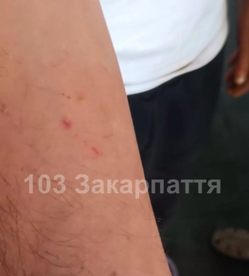 На Тячівщині чоловіка госпіталізували з підозрою на укус змії
