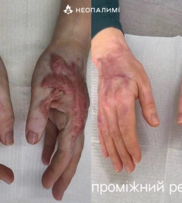 В Одесі постраждалі від війни можуть безкоштовно вилікувати опіки та рубці
