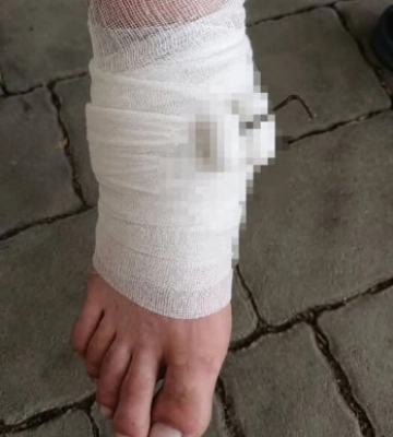 Нещасний випадок на Закарпатті: під час косіння трави чоловік отримав важку травму ноги