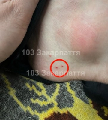 Небезпечна зустріч на Тячівщині: отруйна змія напала на 61-річного чоловіка (ФОТО)