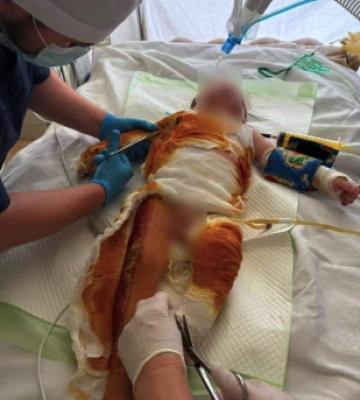 У Чернівцях лікарі врятували дитину з тяжкими опіками, яку доправили у критичному стані