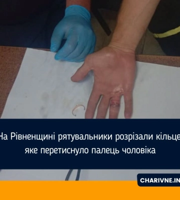 У Дубні рятувальники зняли кільце, яке застрягло на пальці чоловіка
