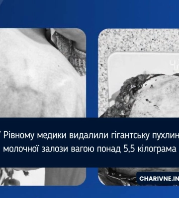 У Рівному медики видалили гігантську пухлину молочної залози вагою понад 5,5 кілограма