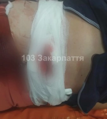 Жителька Мукачівщини впала зі сходів на скляну банку