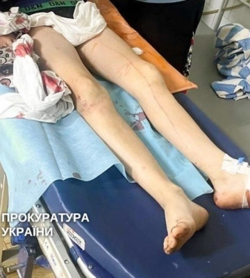 Ротвейлери покусали двох підлітків на Рівненщині: власника собак судитимуть