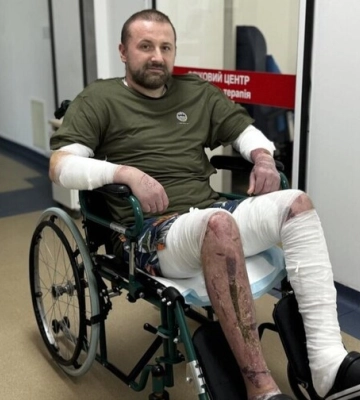 Лікарі врятували львівʼянина після серйозного опіку завдяки шкірі риби та свині