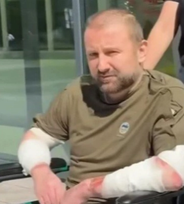 Рани закривали шкірою свині та риби: у Львові врятували чоловіка з опіками 80% тіла через вибух бойлера