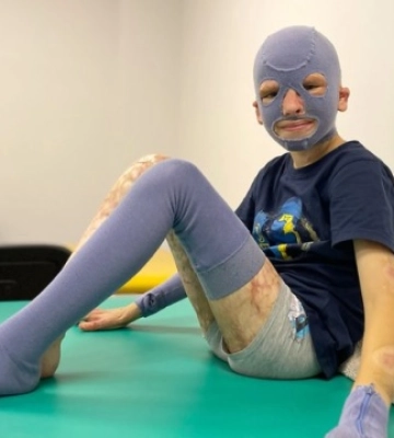Хлопчику, який постраждав від російського ракетного удару по Вінниці, провели 37-му операцію